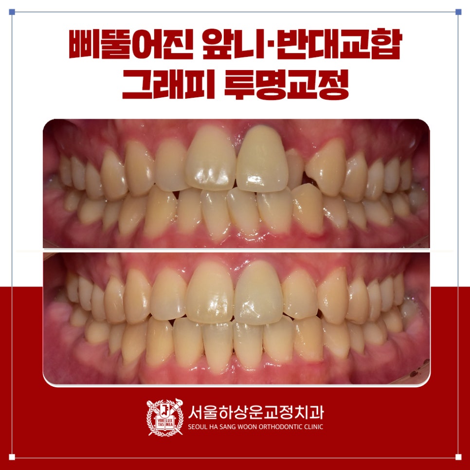 분당 교정치과 삐뚤어진 앞니·반대교합 그래피 투명교정