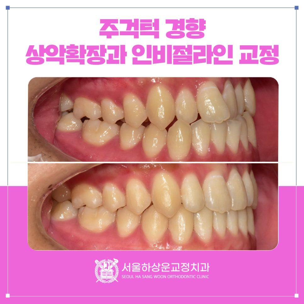 용인 교정치과 상악확장으로 주걱턱 경향 개선한 인비절라인 교정