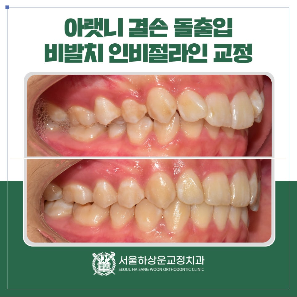 성남 교정치과 아랫니 선천적 결손·돌출입, 비발치 인비절라인 교정