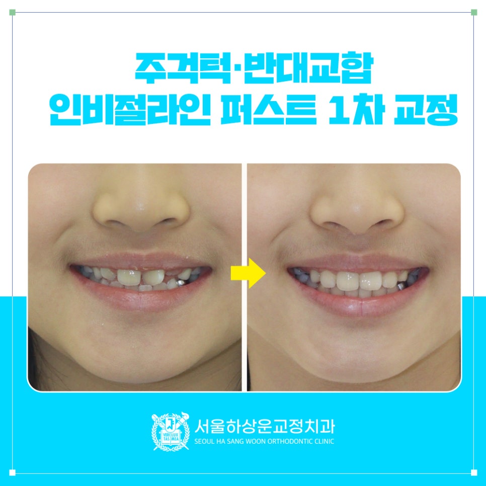 성남 교정치과 주걱턱 경향 있는 앞니 반대교합 1차 교정