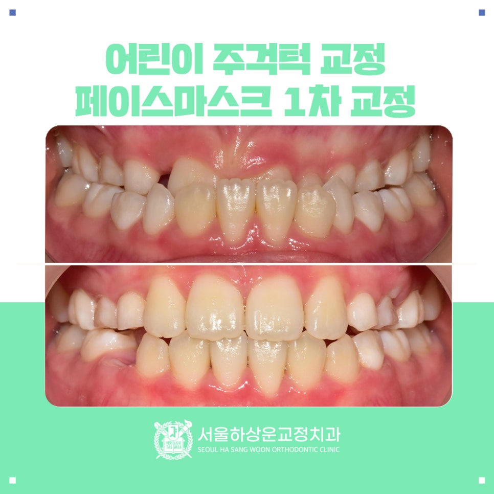 분당 교정치과 어린이 주걱턱 교정, 페이스 마스크 1차 교정