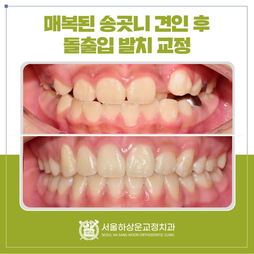 성남 교정치과 매복된 송곳니 견인 후 돌출입 발치 교정(2편)