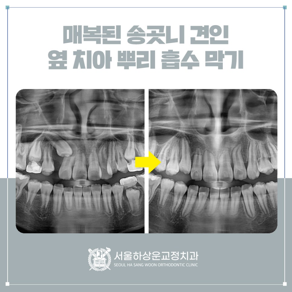 성남 교정치과 매복된 송곳니 견인, 옆 치아 뿌리 흡수 막기(1편)
