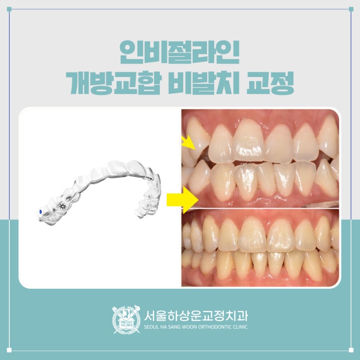 인비절라인 개방교합 교정치료 증례 및 리파인먼트(Refinement) 설명 글