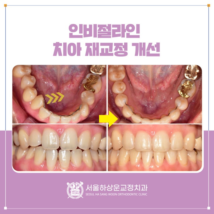 치아 재교정 치료, 인비절라인으로 진행했었던 사례