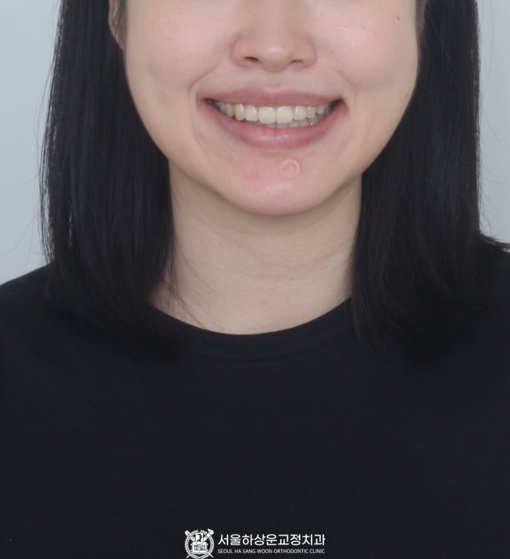 미금역 치과에서 인비절라인 으로 환하게 웃으세요.