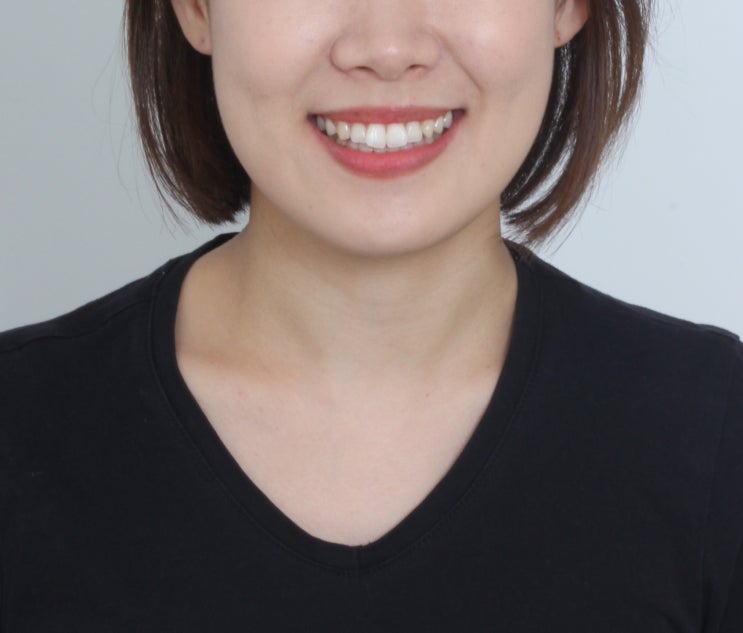 분당 인비절라인 비발치 돌출입 개선 치아교정 증례