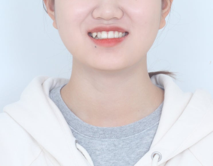 악궁확장장치 를 활용했던, 치아교정 임상 증례입니다.