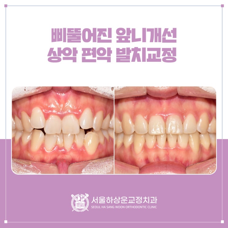상악 작은어금니 발치 후 분당 치아교정 을 통해 아름다운 미소를 짓게 해드렸습니다.