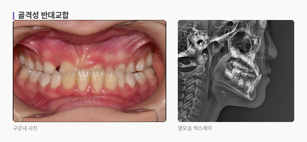 골격성 반대교합 구강내 사진과 옆모습 엑스레이