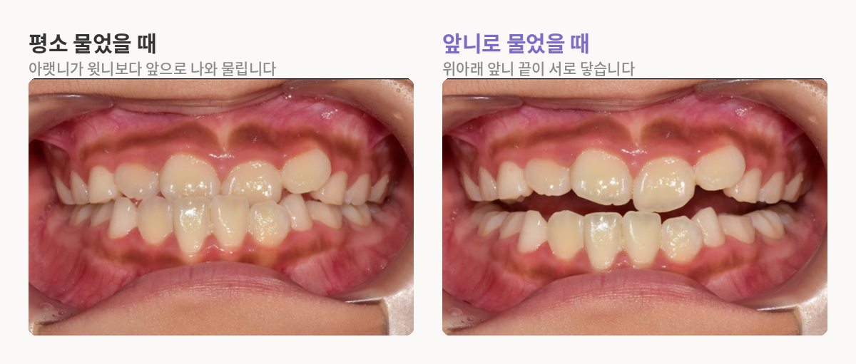 평소 물었을 때와 앞니로 물었을 때 앞니가 물리는 모습 비교