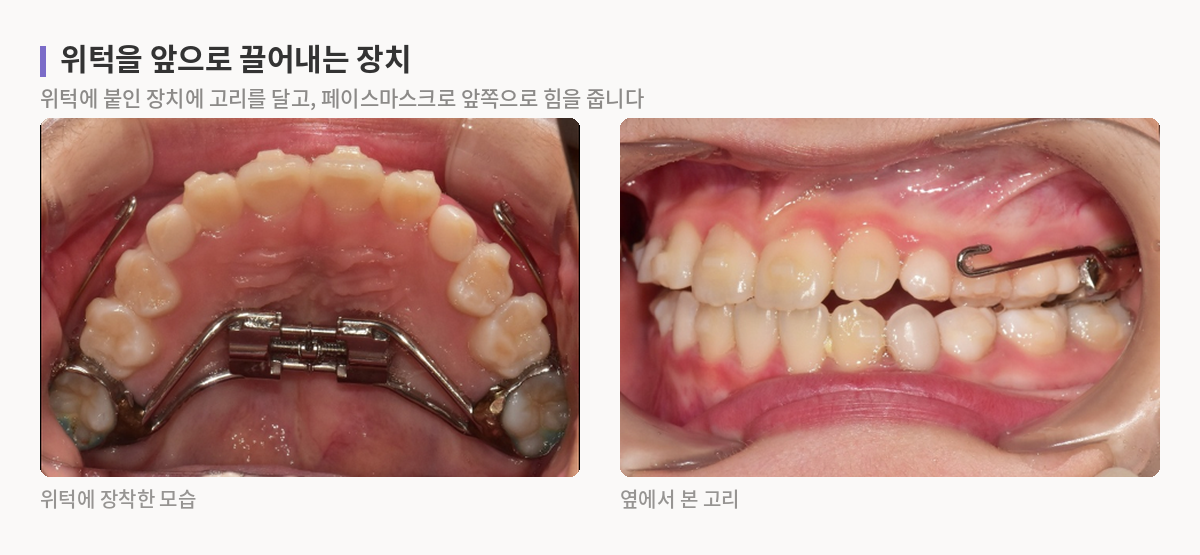 어린이 반대교합 1차 교정에서 위턱에 장착한 확장 장치와 페이스마스크를 거는 고리