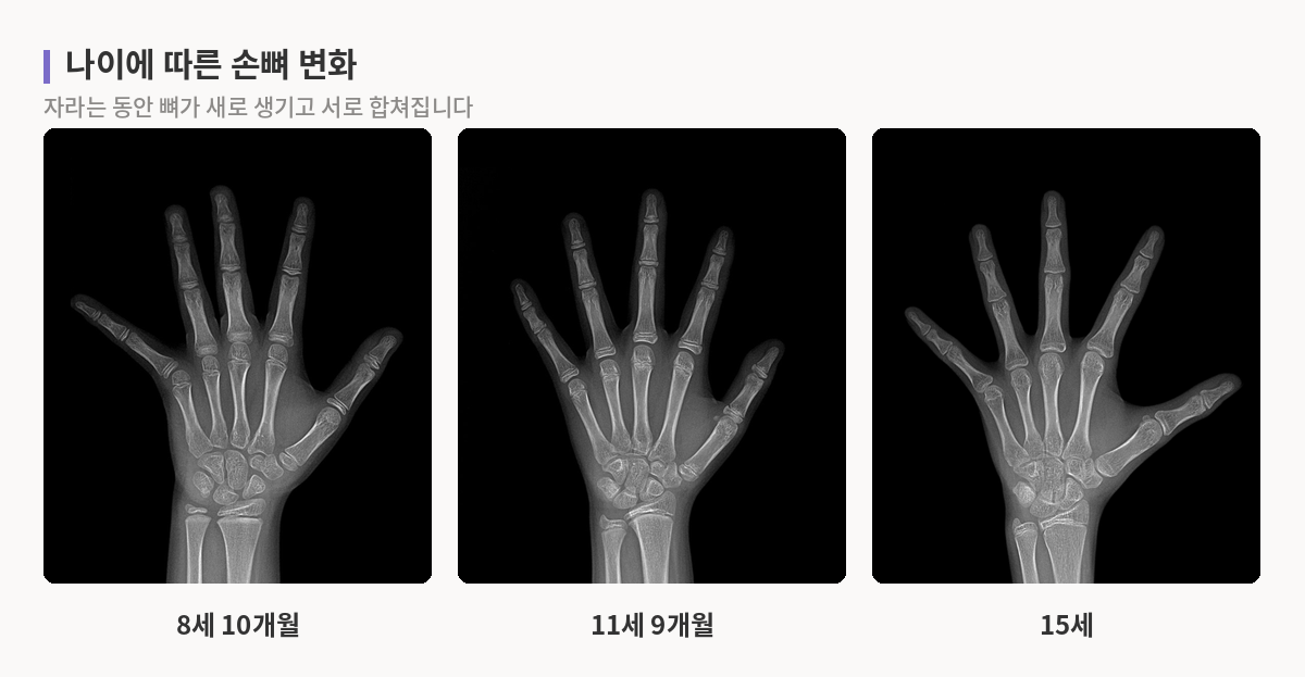 8세·11세·15세 손 엑스레이에서 뼈의 수와 모양이 달라지는 모습