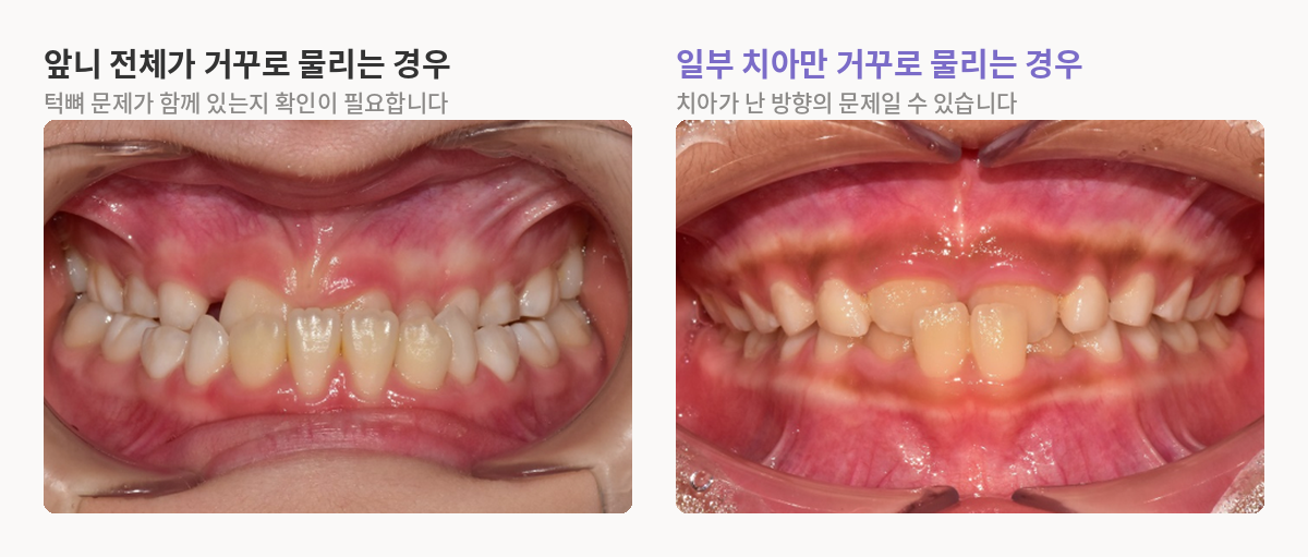 앞니 전체가 거꾸로 물리는 경우와 일부 치아만 거꾸로 물리는 경우 비교