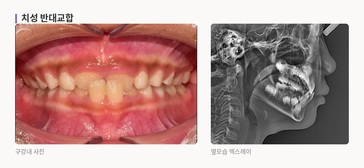 치성 반대교합 구강내 사진과 옆모습 엑스레이