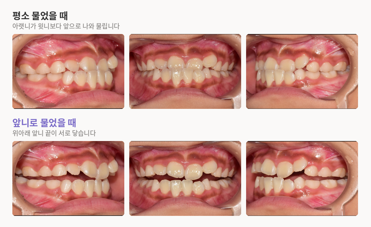 기능성 반대교합, 아래턱을 내밀어 물 때와 앞니로 물 때 비교
