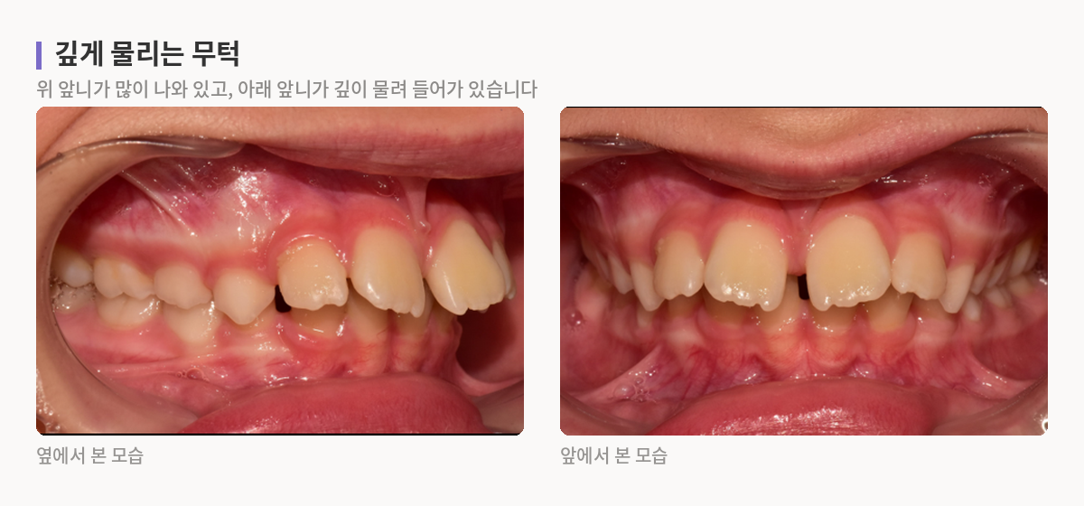 위 앞니가 많이 나와 있고 아래 앞니가 깊이 물려 들어간 무턱 사례