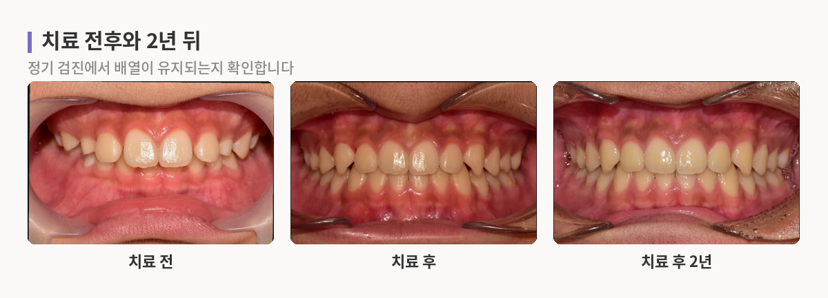 치료 전, 치료 후, 치료 후 2년의 구강내 정면 사진 비교