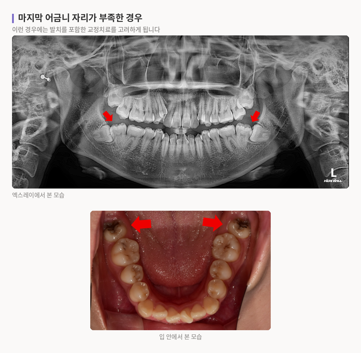 마지막 어금니가 나올 공간이 부족해 발치를 포함한 교정치료가 필요한 상태의 파노라마와 아래턱 교합면 사진